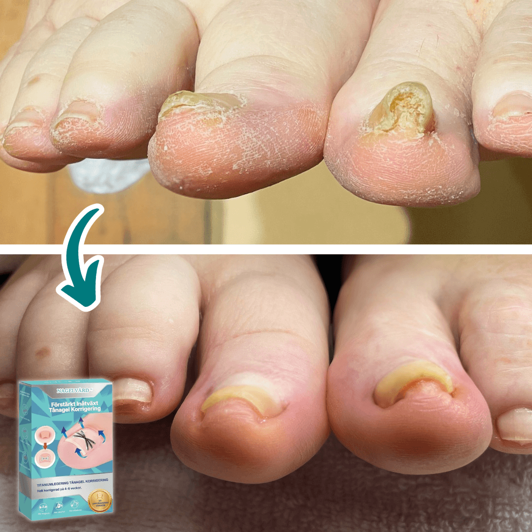 Nagelvård™ Tånagelskorrigerare